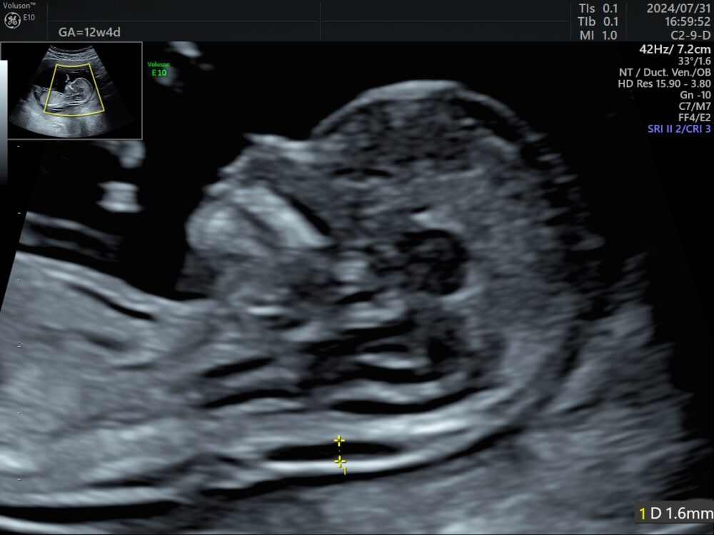胎児ドック・初期精密超音波検査（妊娠12〜13週）
